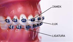 Z czego się składa aparat stomatologiczny stały w neptune dent gdańsk