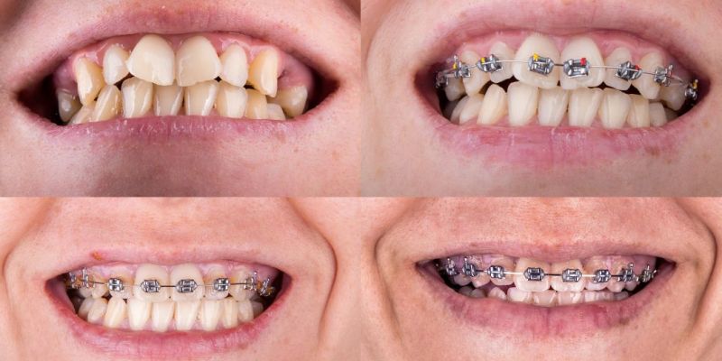 aparat na zęby przed i po zabiegu